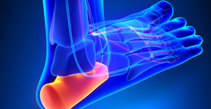 Plantar Fasciitis can range from straining a ligament in your arch to poor posture and the way you walk, leading to pain and swelling - Fircrest, Tacoma, University Place, Washington
